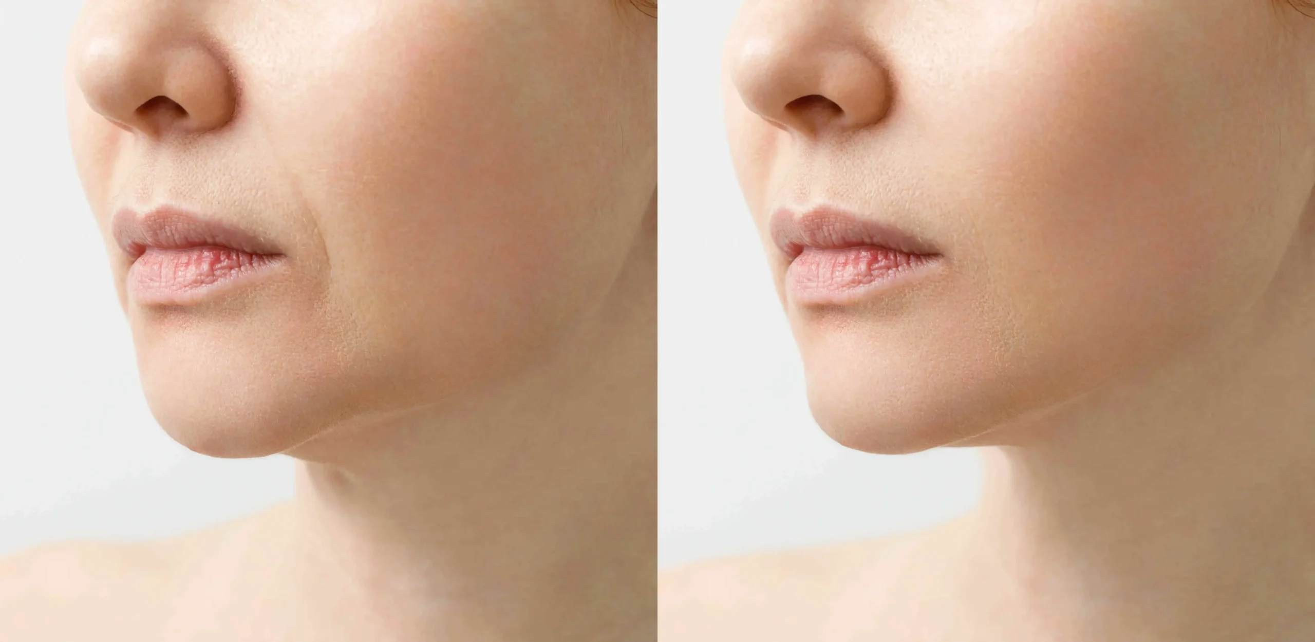 Profhilo Treatment in London: What It Is, How It Works & Who It’s For